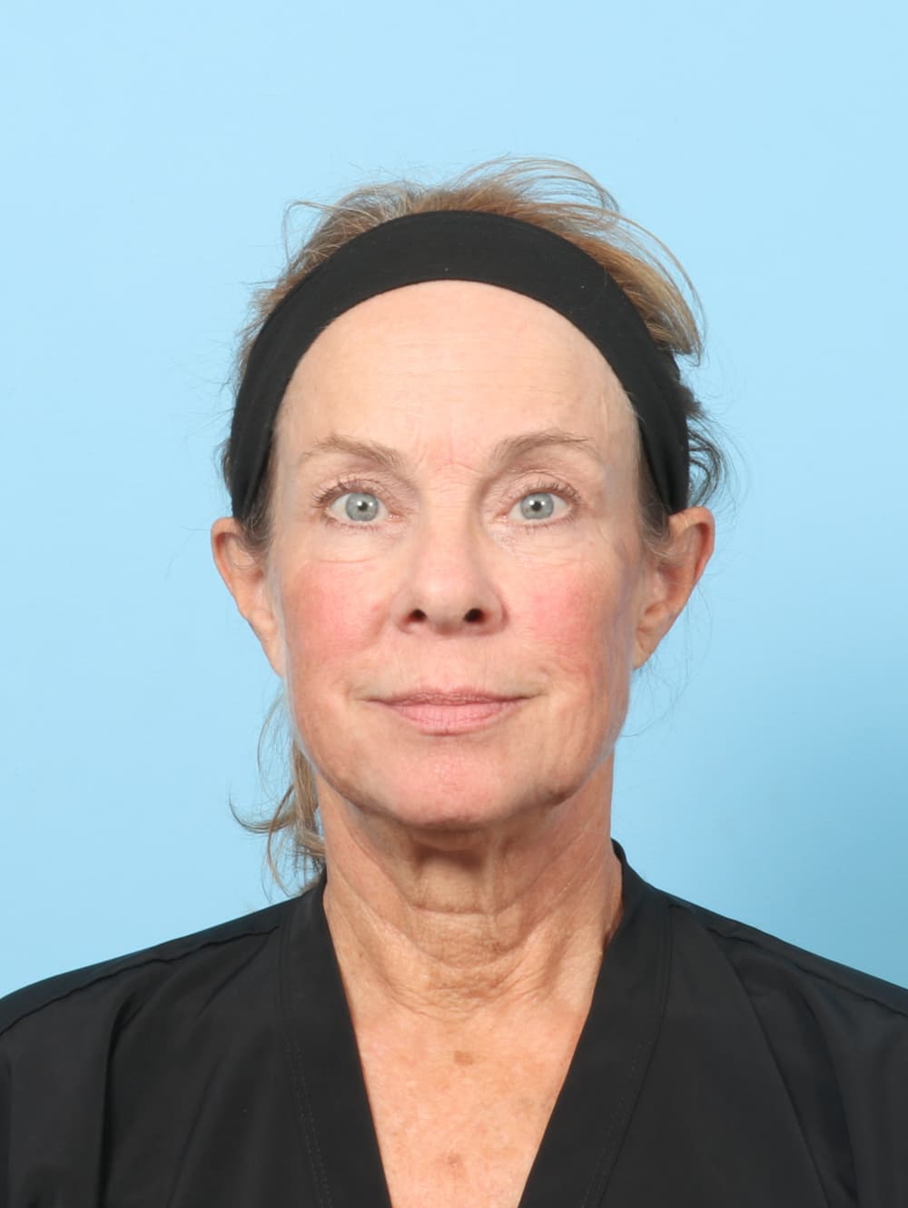Eyelid Surgery case #8602 after
