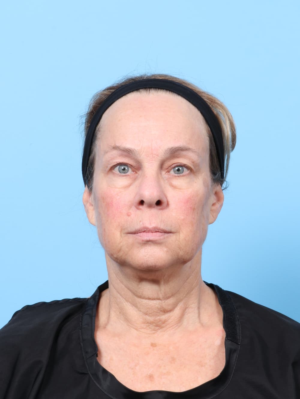 Eyelid Surgery case #8602 before