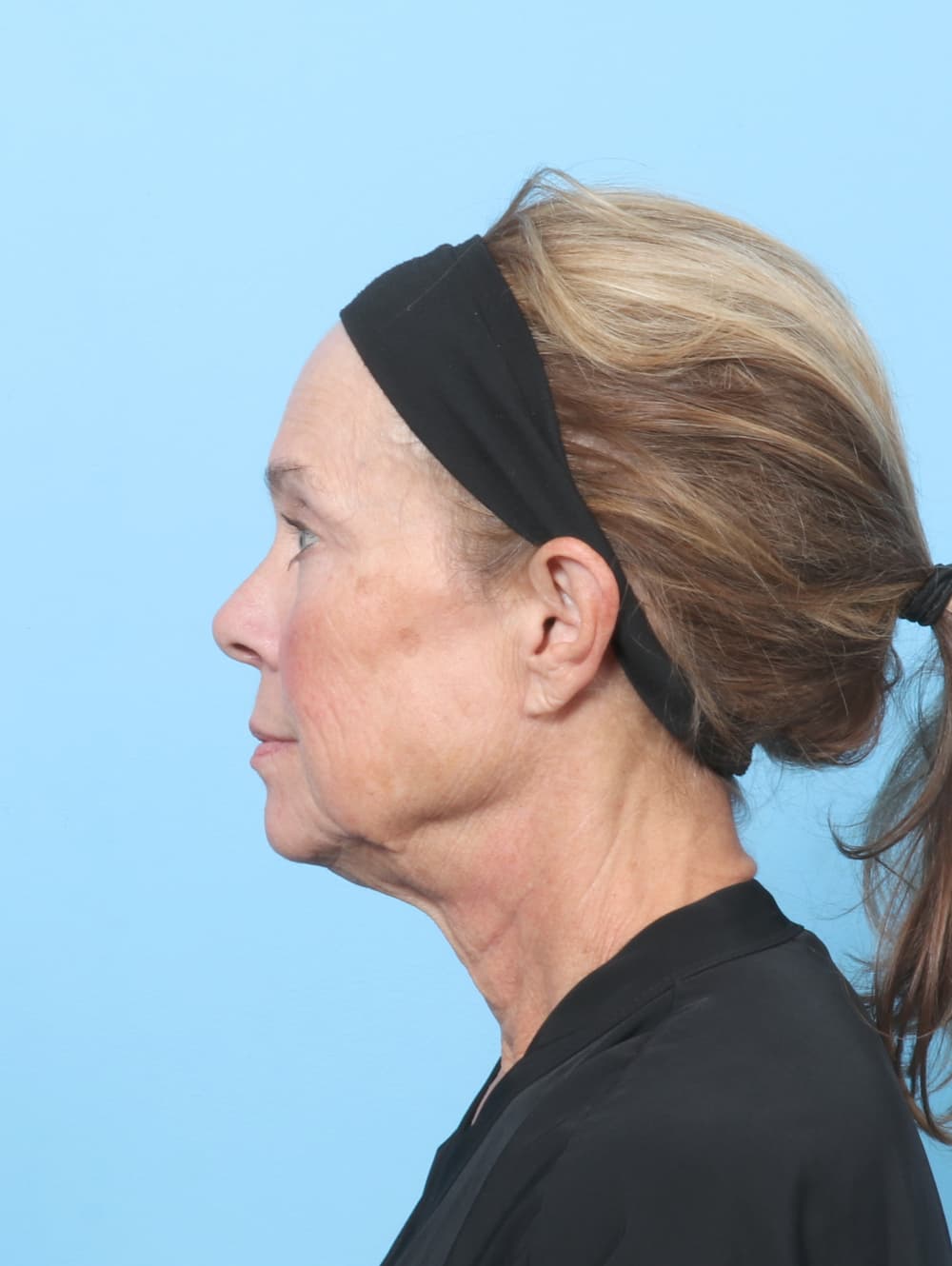 Eyelid Surgery case #8602 after, image 3