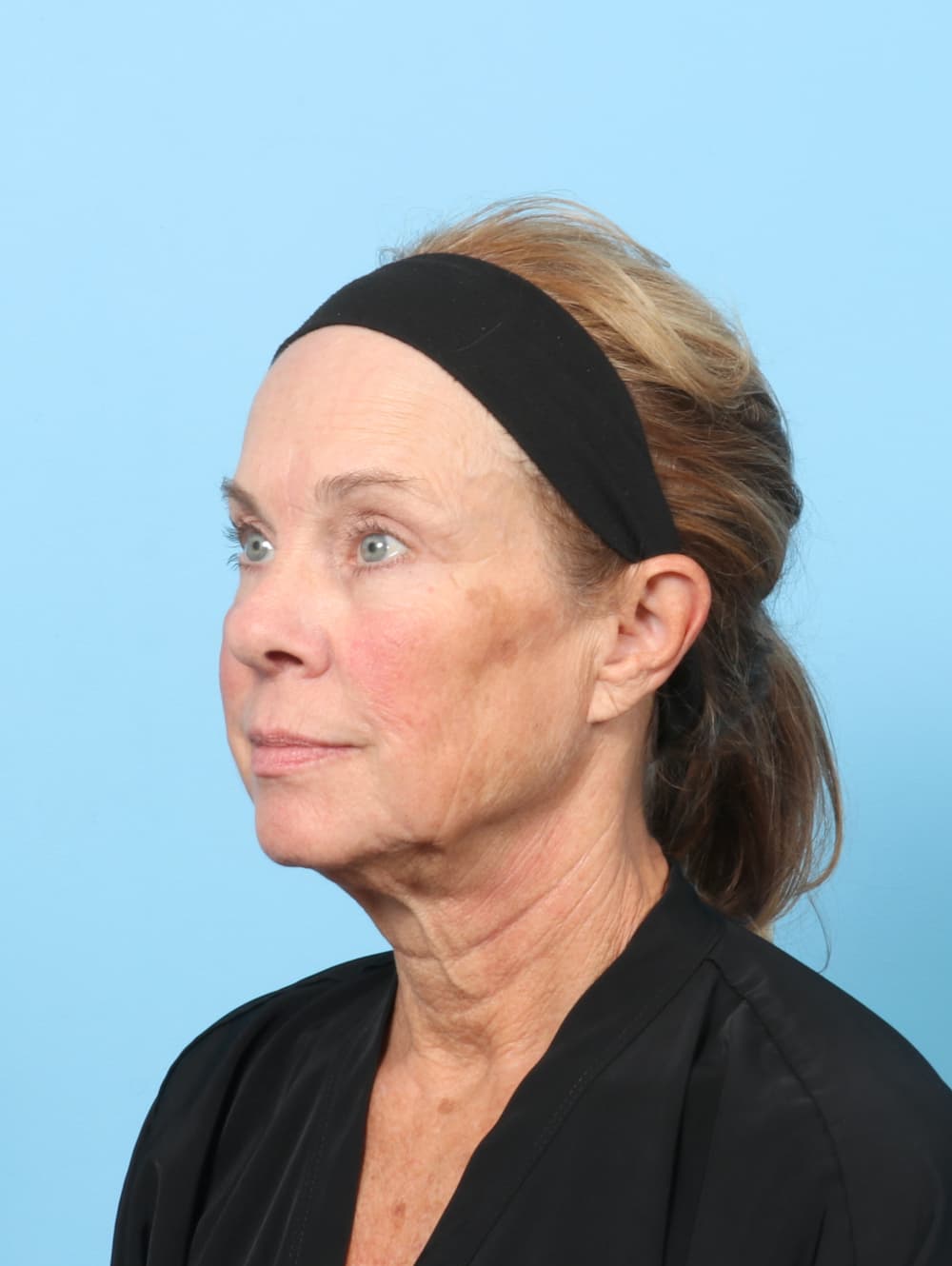 Eyelid Surgery case #8602 after, image 2