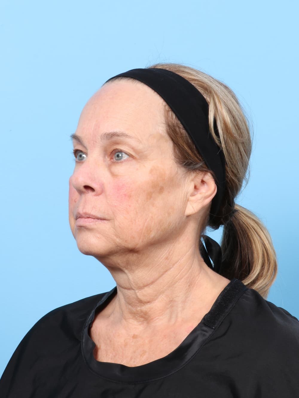 Eyelid Surgery case #8602 before, image 2