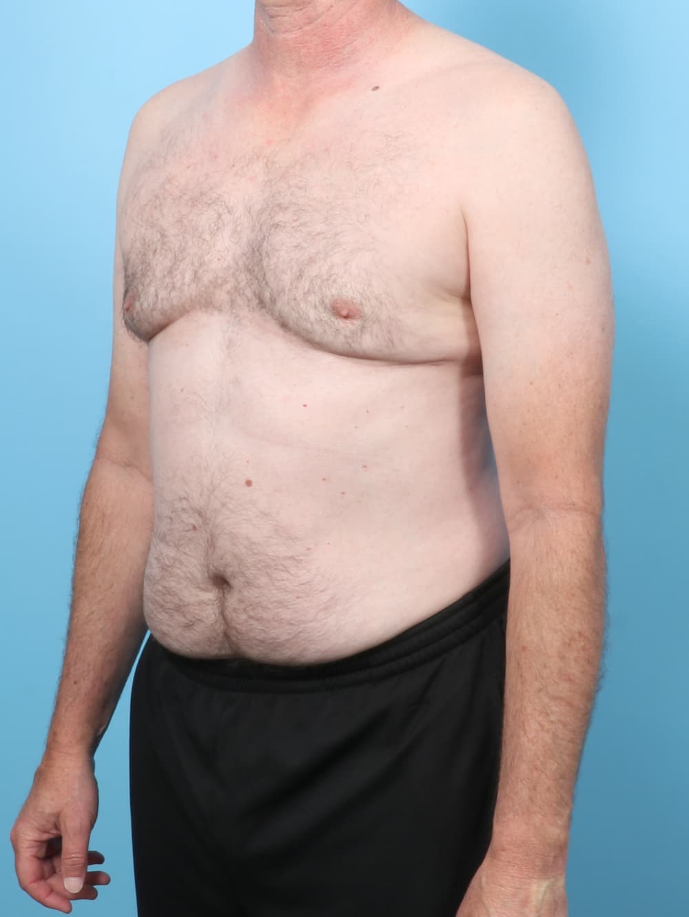 Male Breast Reduction case #8006 after, image 2