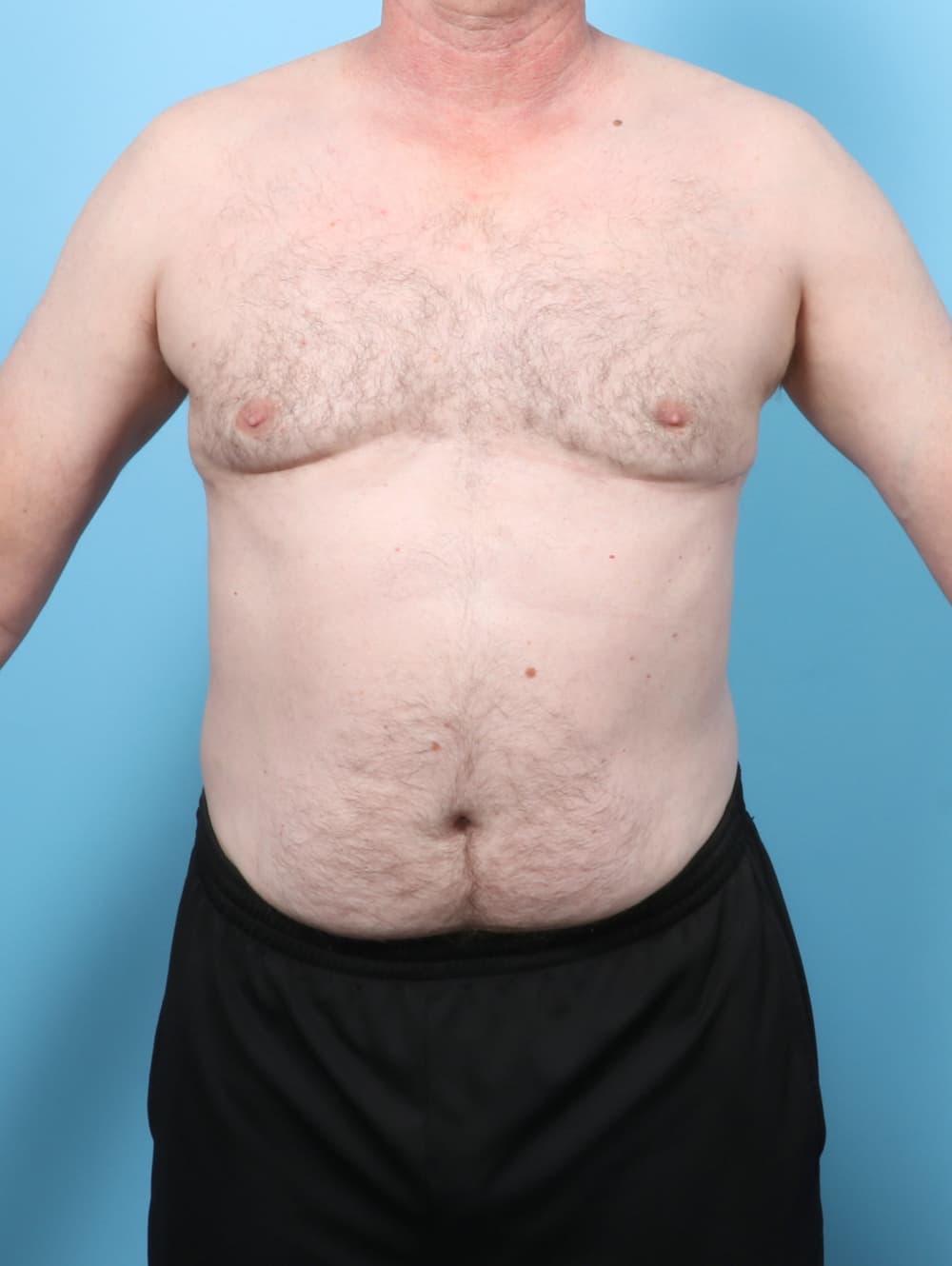 Male Breast Reduction case #8006 after, image 1