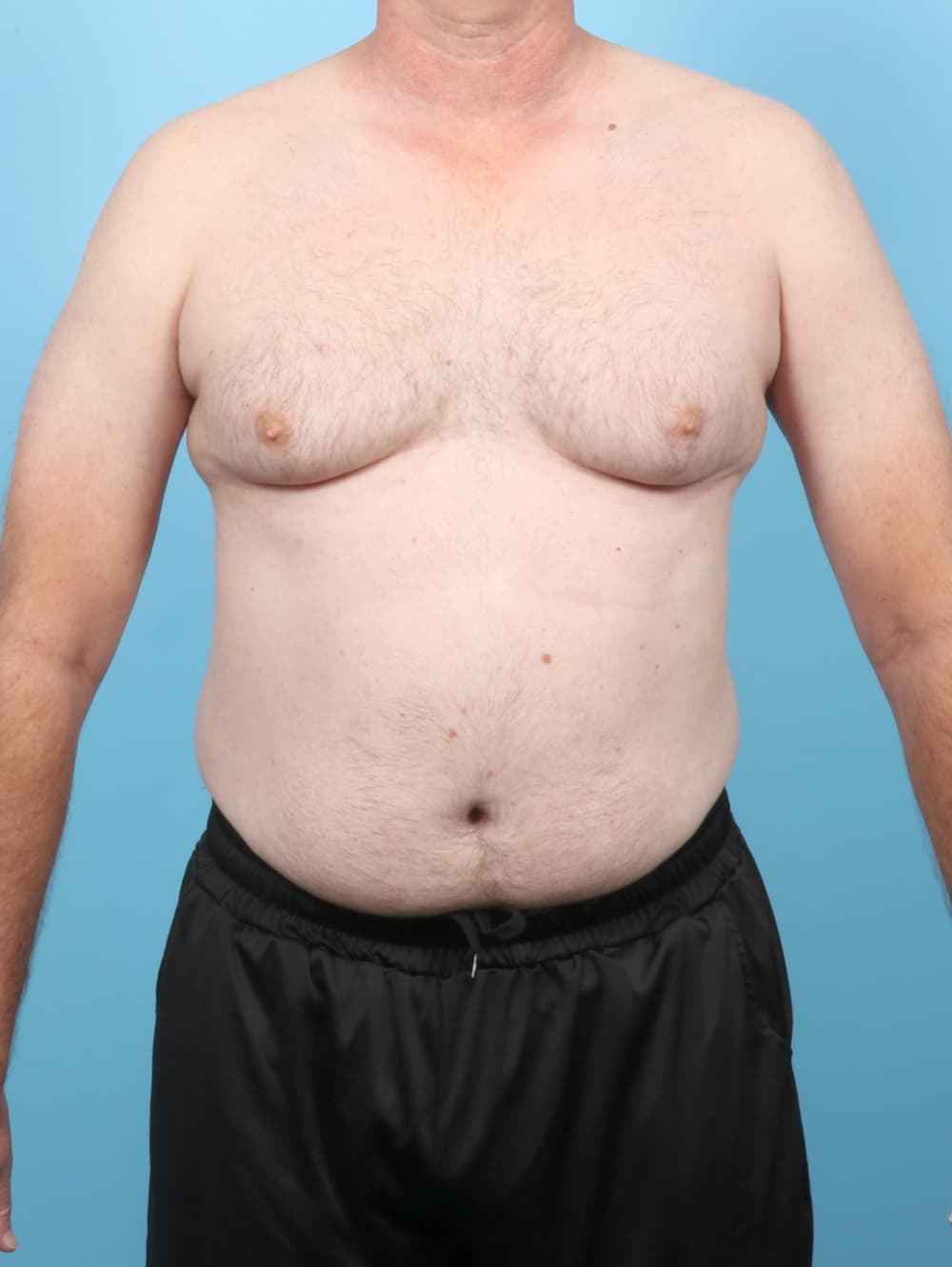Male Breast Reduction case #8006 before, image 1