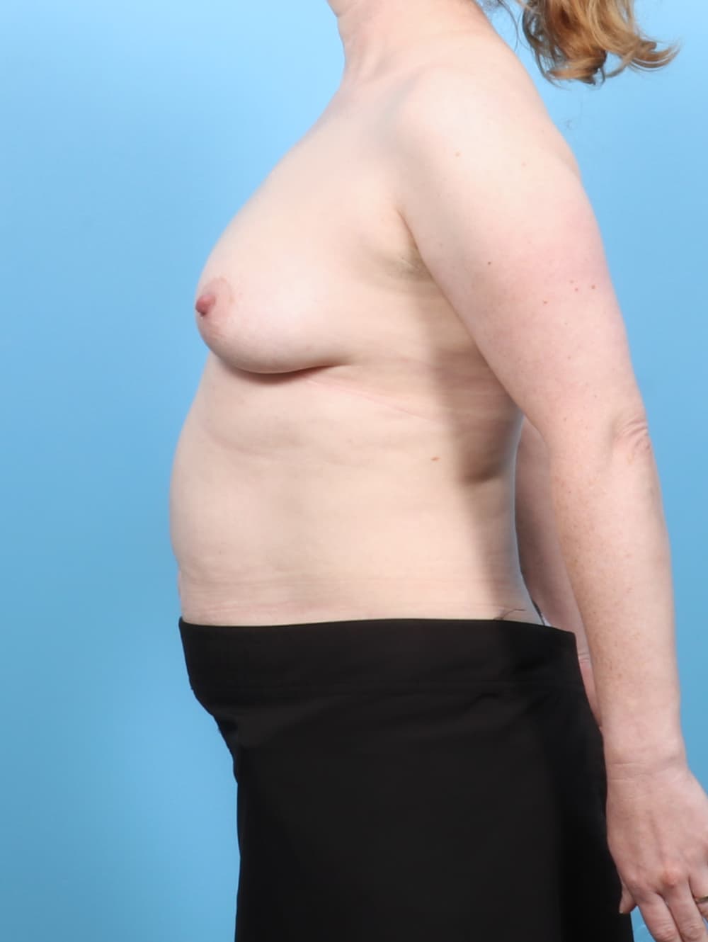 Breast Augmentation case #7598 before, image 3