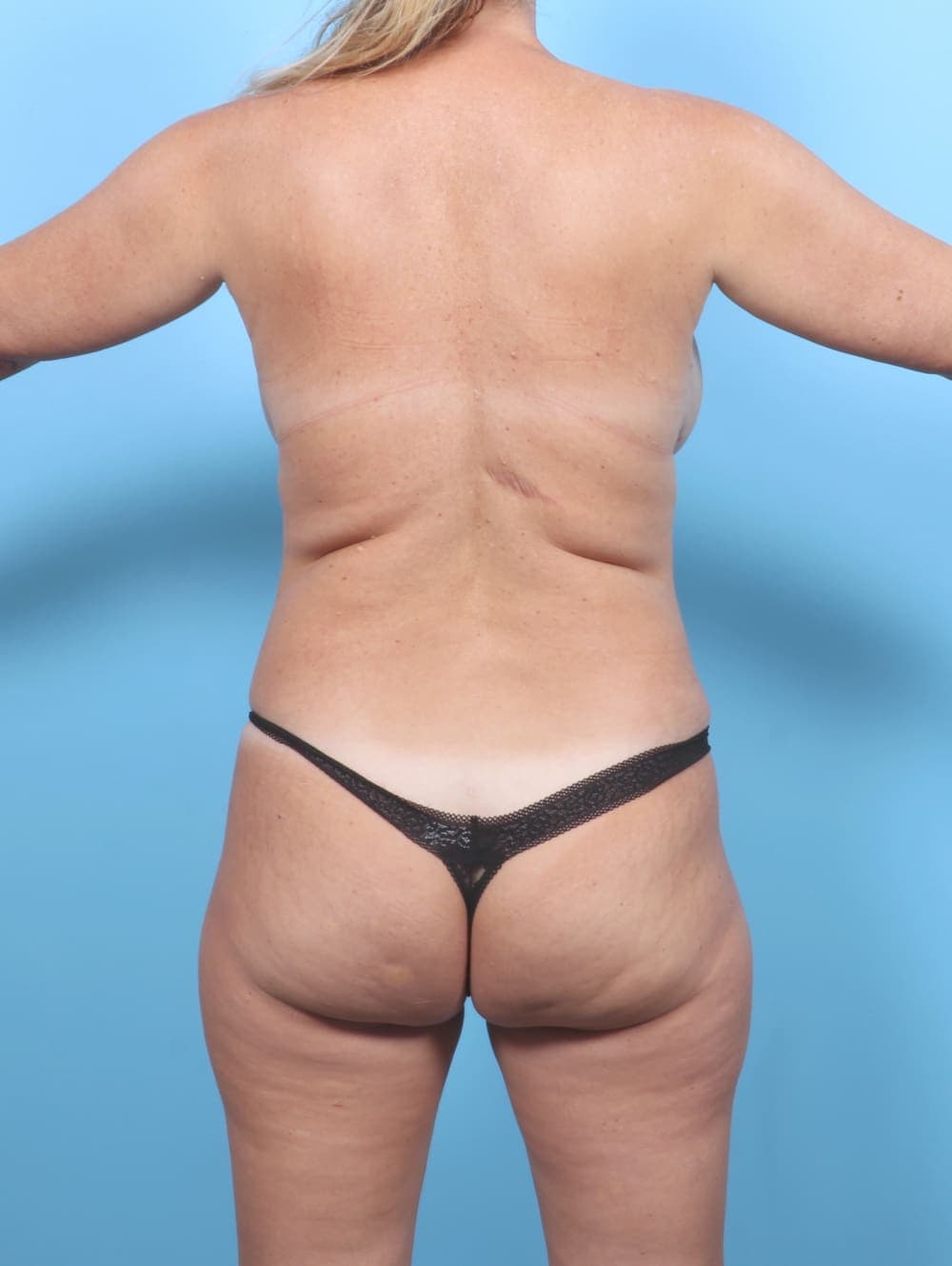 Liposuction case #6625 after, image 4