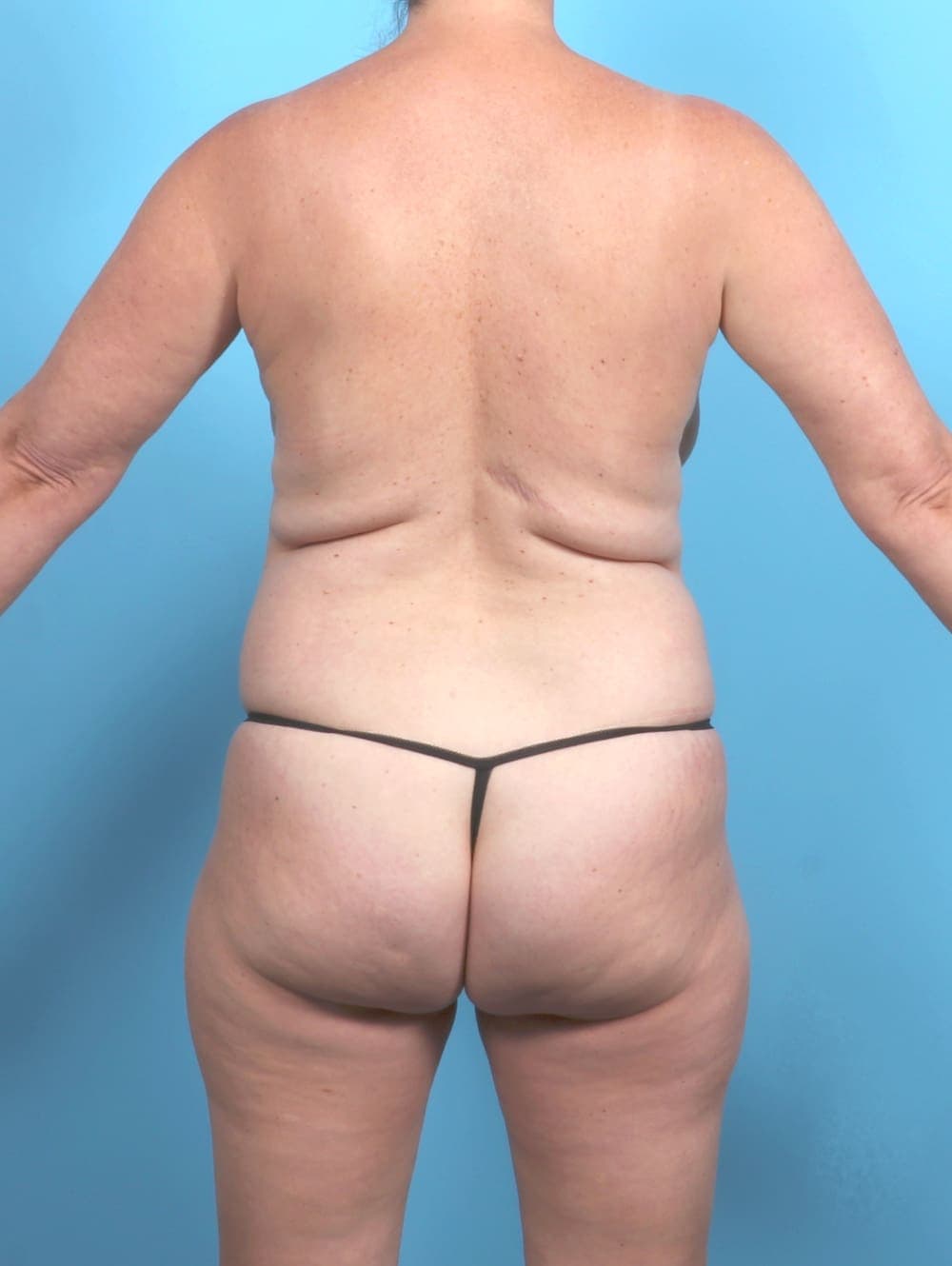 Liposuction case #6625 before, image 4