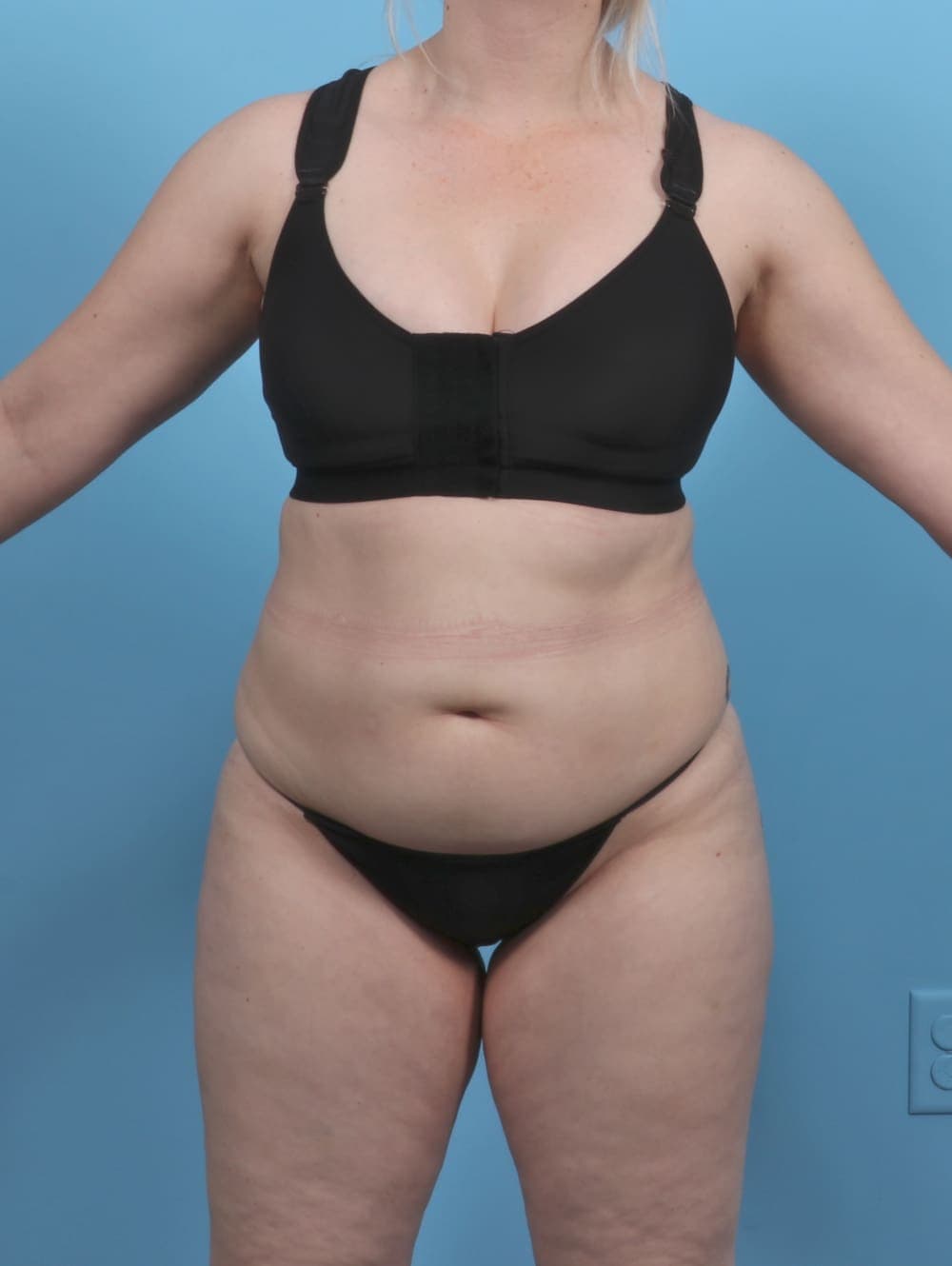 Liposuction case #5514 after, image 1