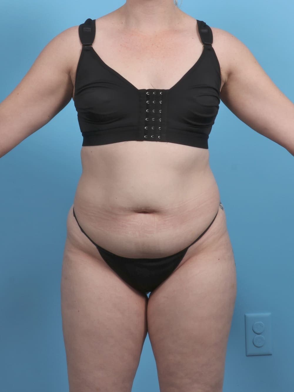 Liposuction case #5514 before, image 1