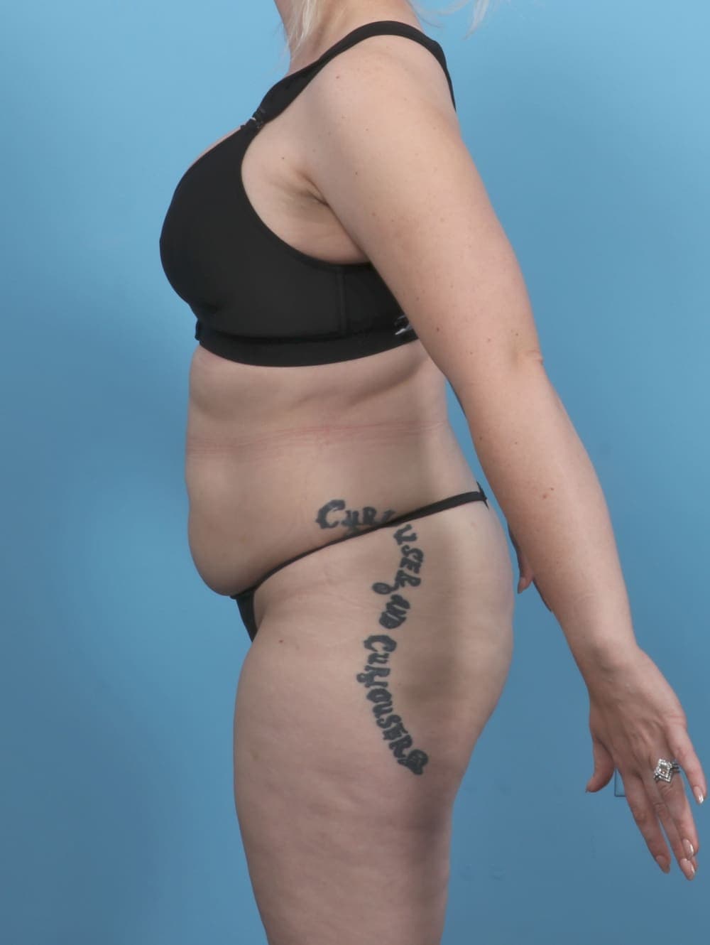 Liposuction case #5514 after, image 4