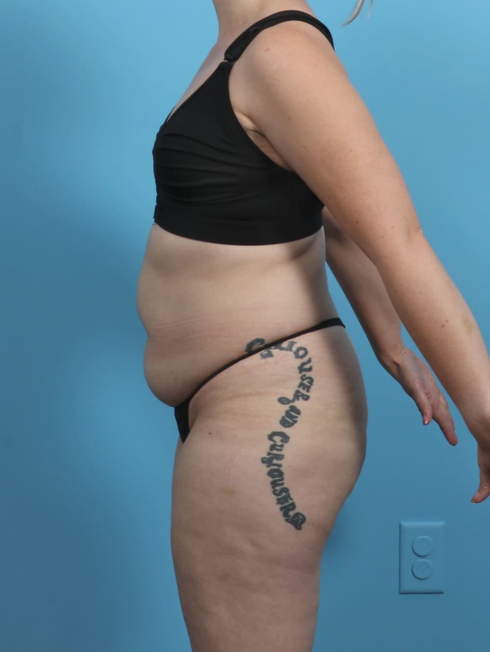 Liposuction case #5514 before, image 4