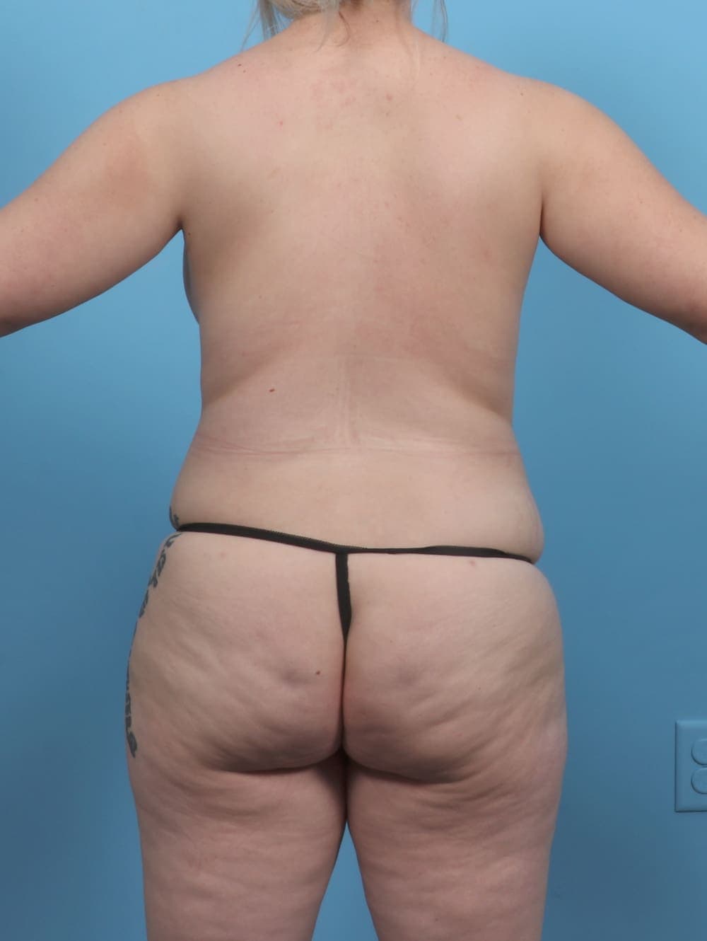 Liposuction case #5514 after, image 2