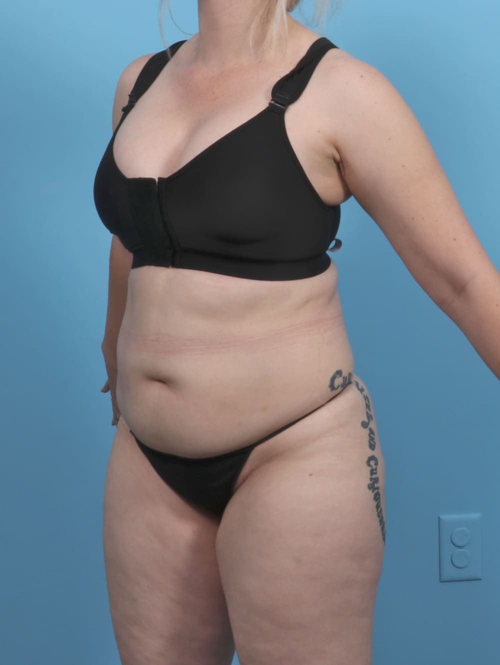 Liposuction case #5514 after, image 3