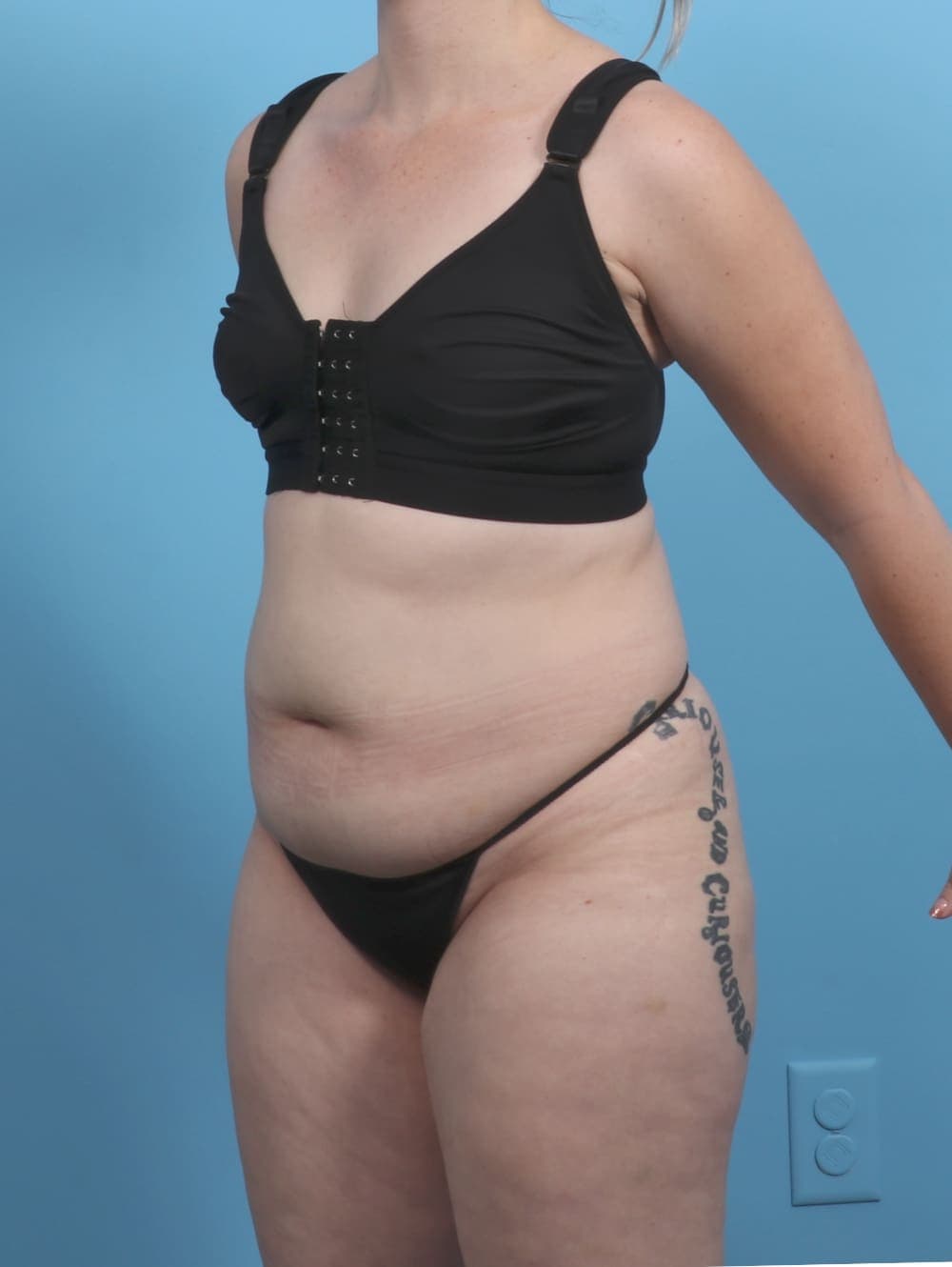 Liposuction case #5514 before, image 3
