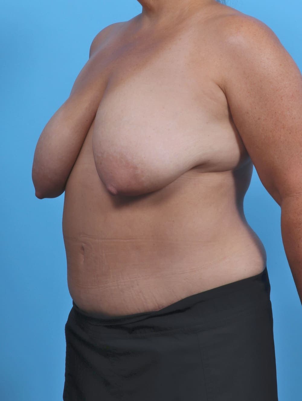 Breast Lift/Reduction case #5068 before, image 2