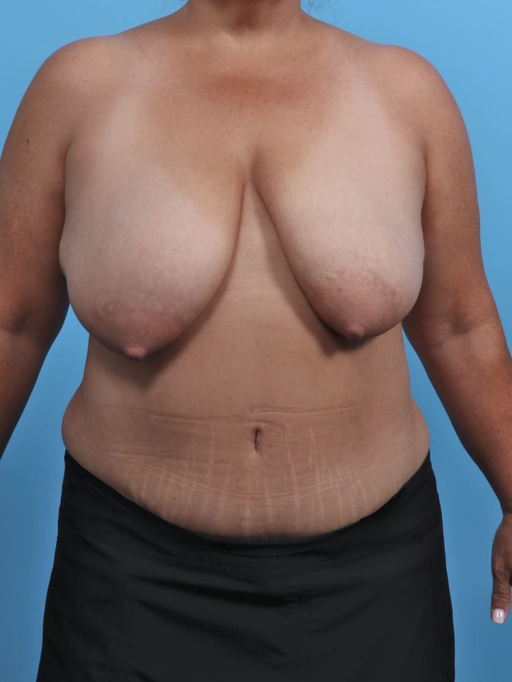 Breast Lift/Reduction case #5068 before, image 1