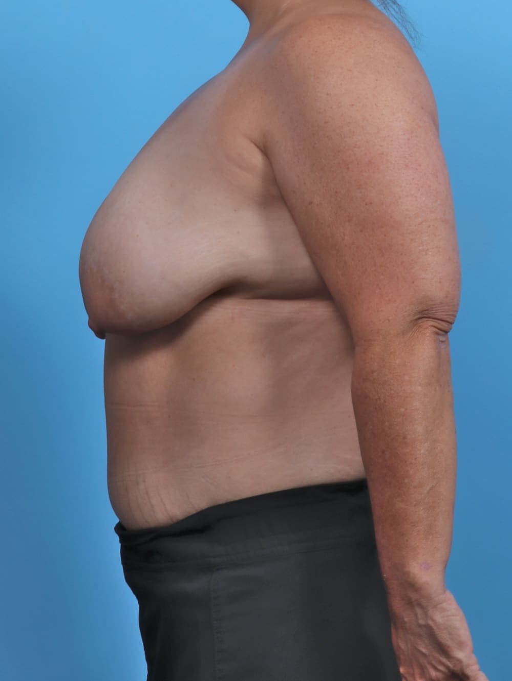 Breast Lift/Reduction case #5068 before, image 3