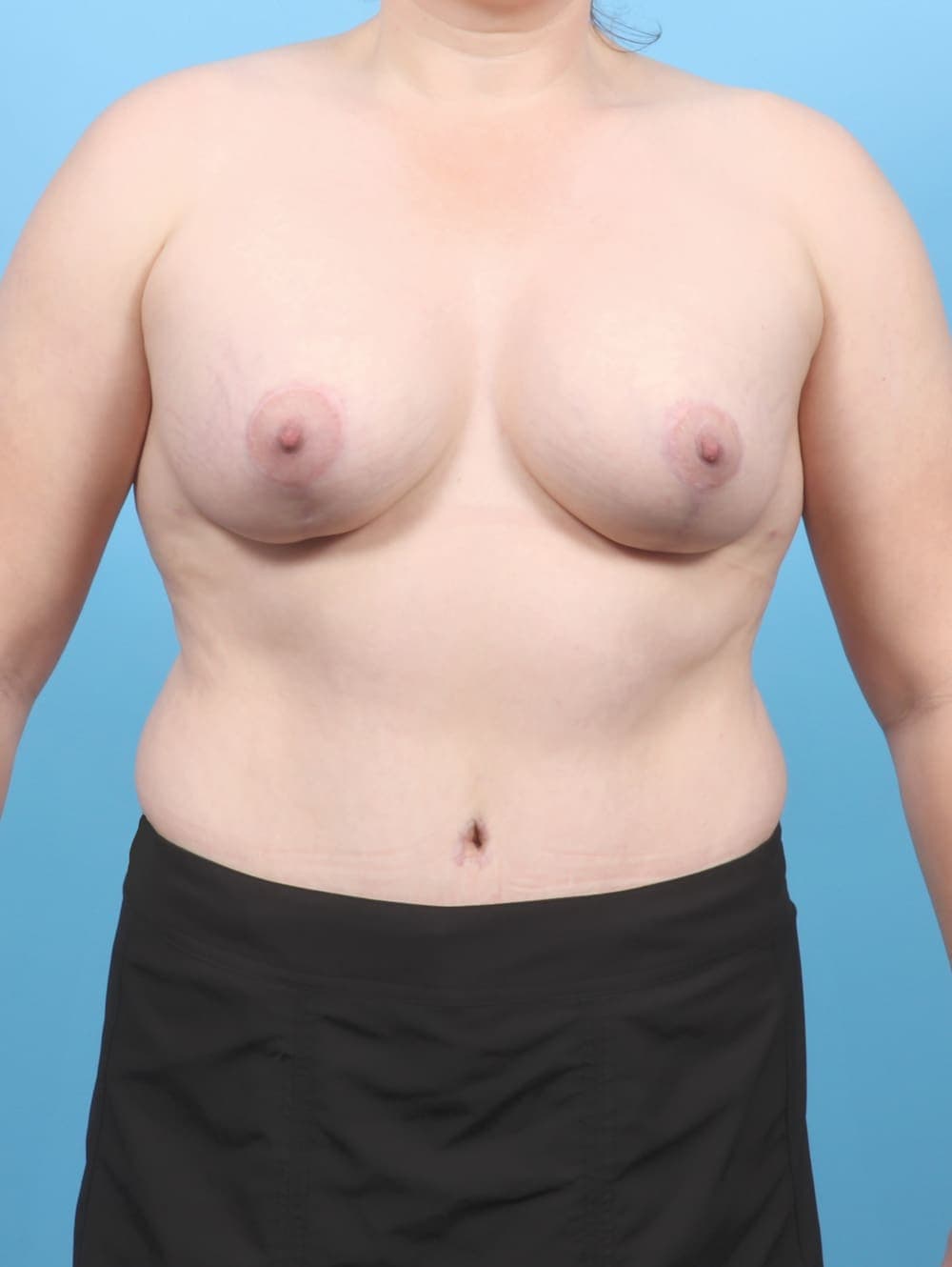 Breast Lift/Reduction case #6547 after, image 1