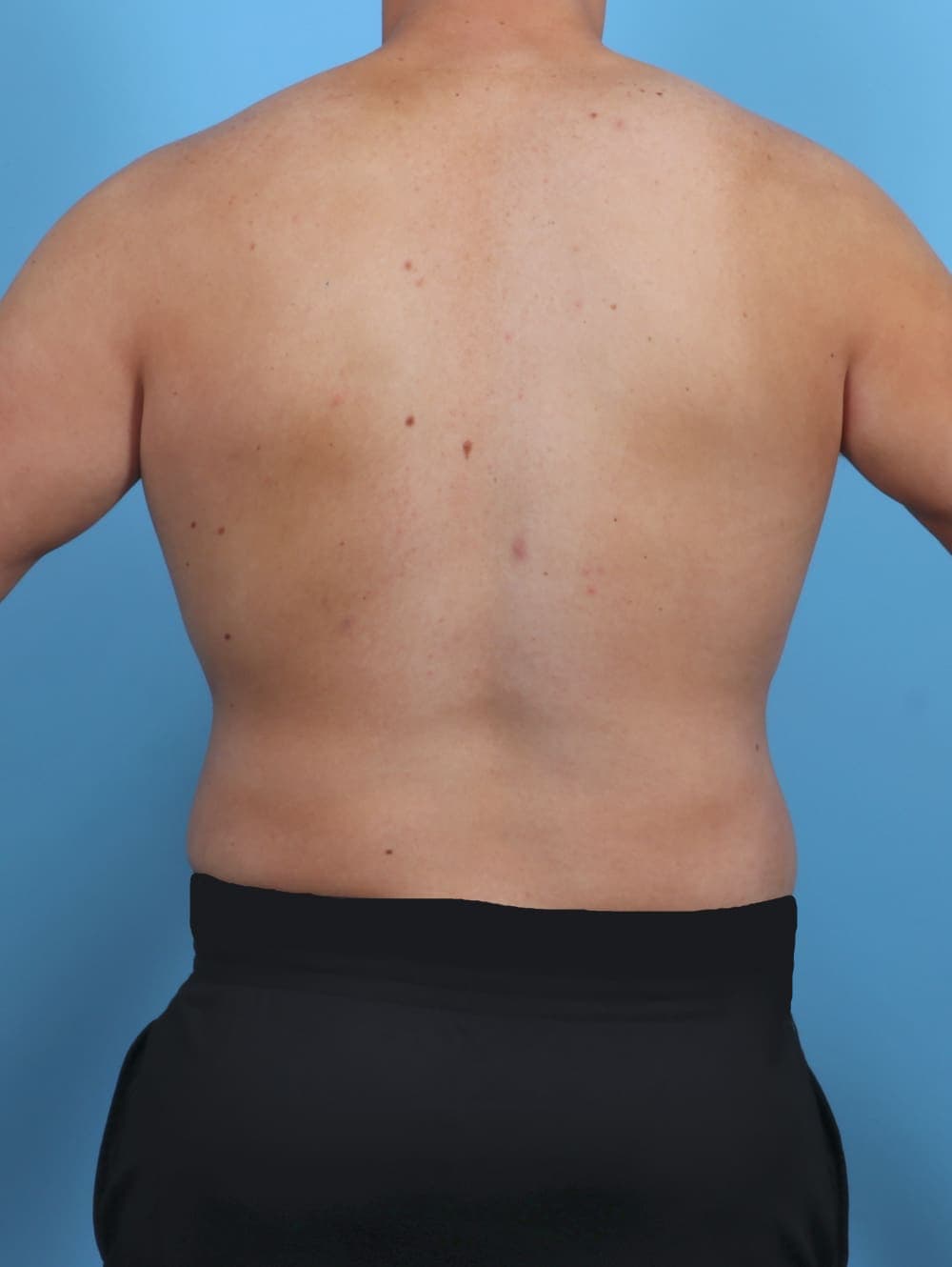 Body Lift case #4892 after, image 4