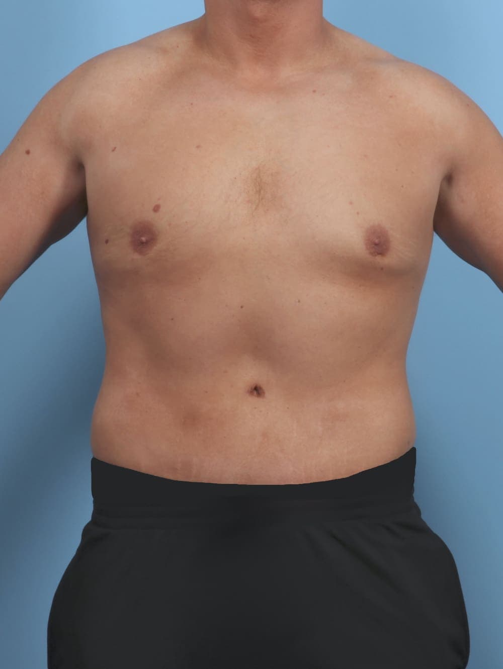 Body Lift case #4892 after, image 1