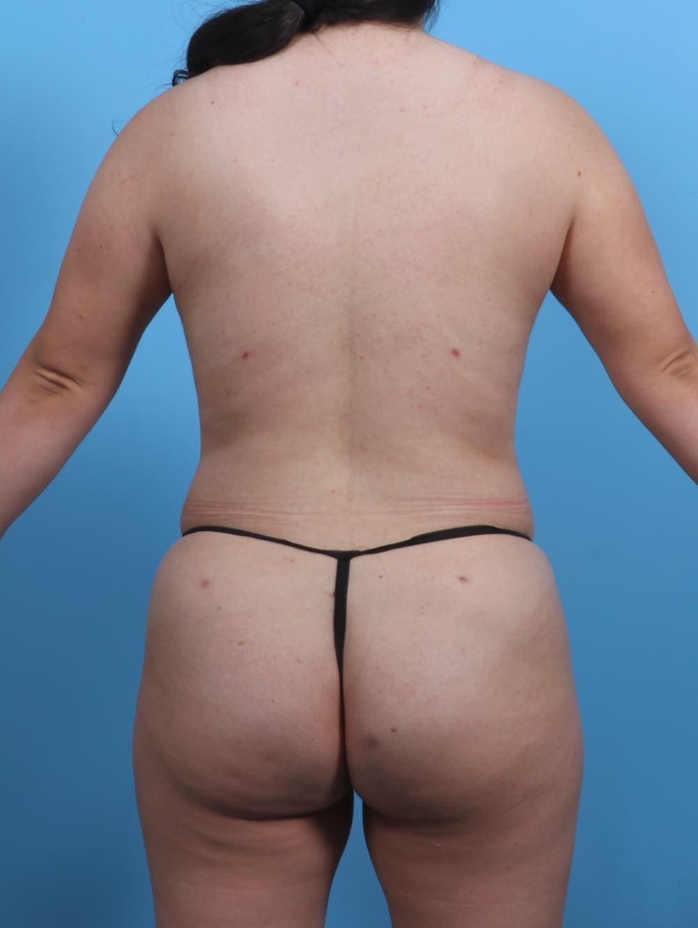 Liposuction case #3683 after, image 4