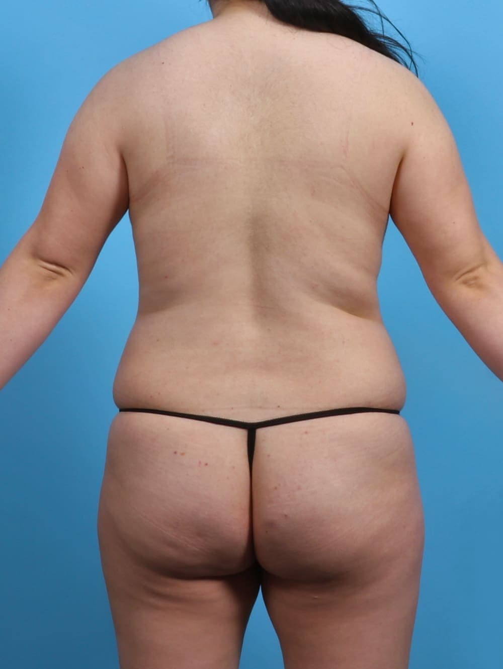 Liposuction case #3683 before, image 4