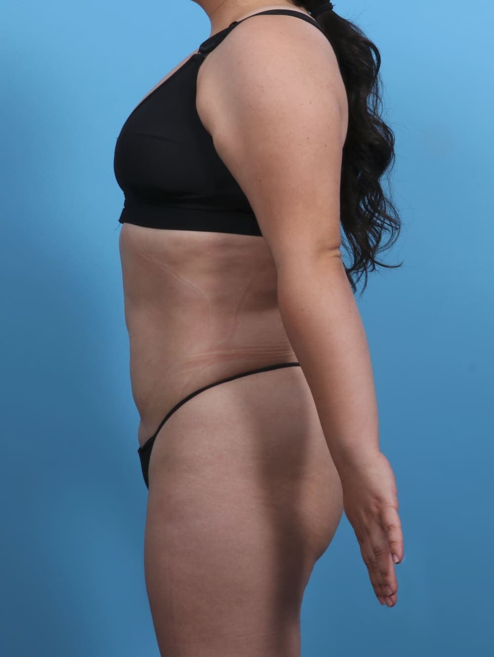 Liposuction case #3683 after, image 3
