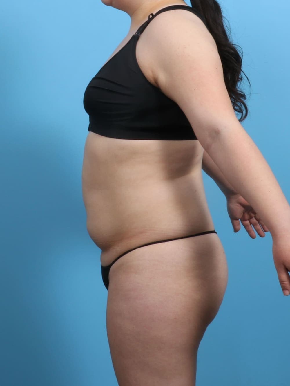 Liposuction case #3683 before, image 3