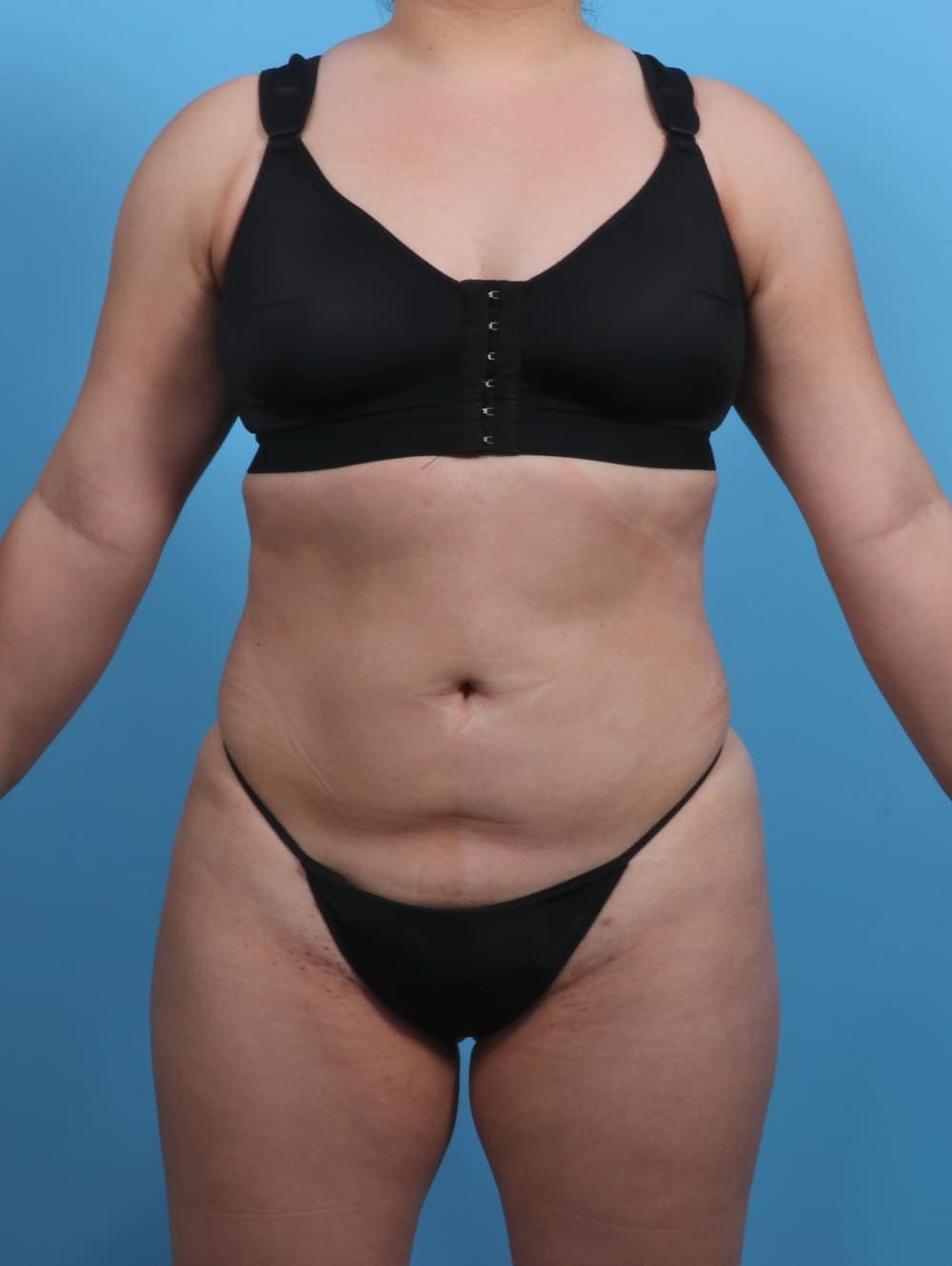 Liposuction case #3683 after, image 1