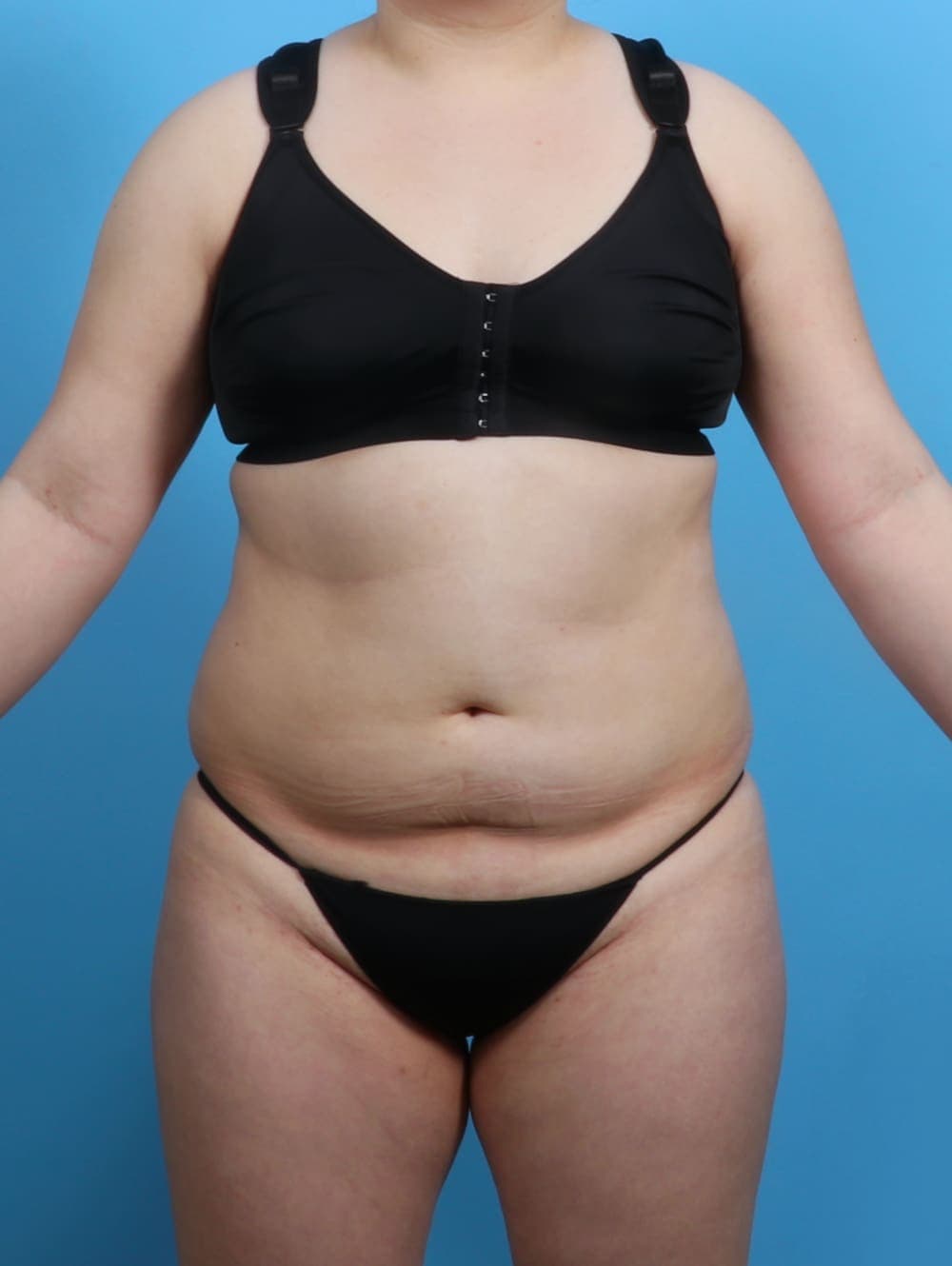 Liposuction case #3683 before, image 1