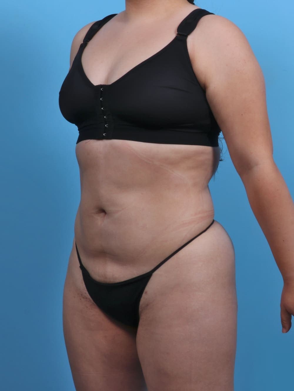 Liposuction case #3683 after, image 2