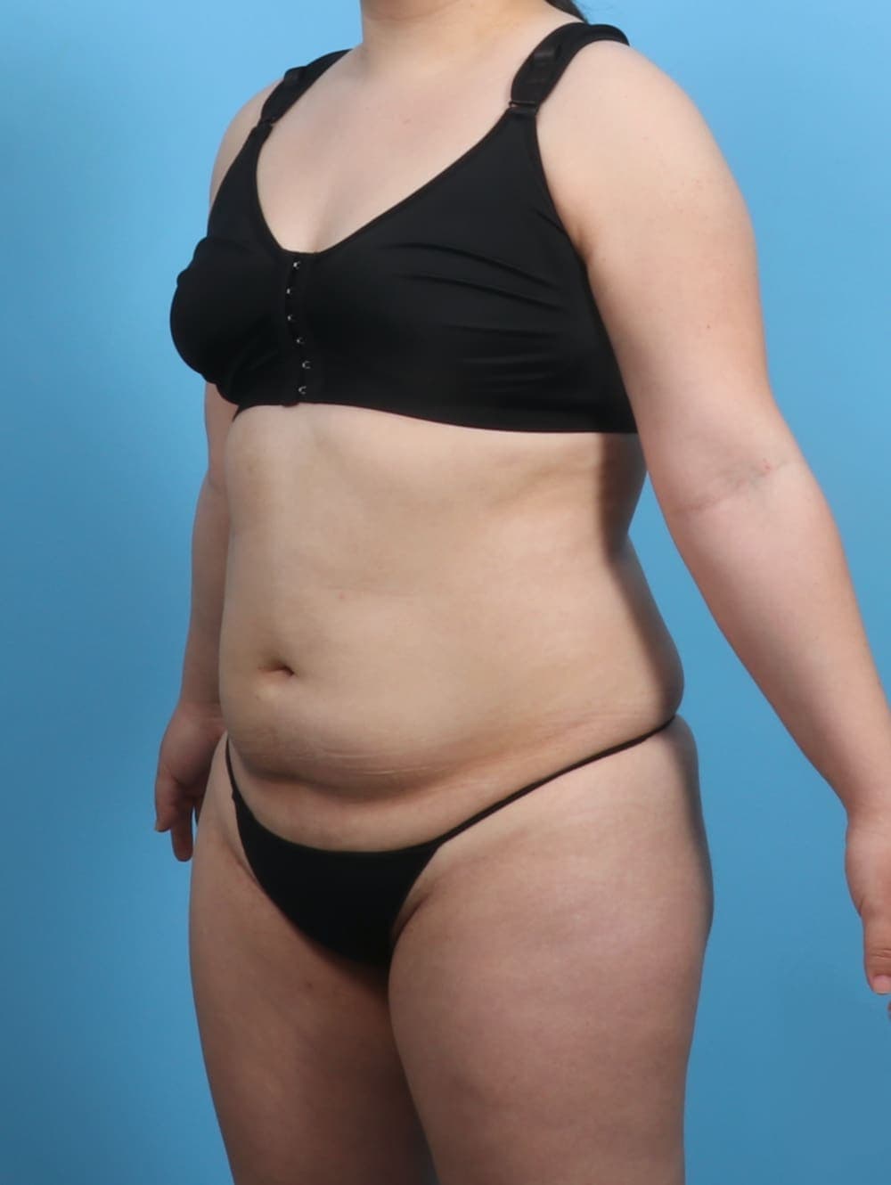 Liposuction case #3683 before, image 2