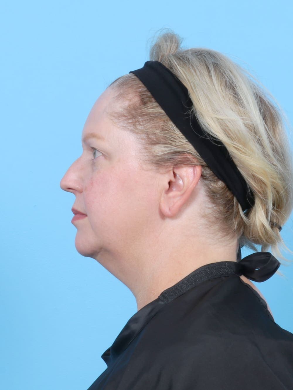 Eyelid Surgery case #6523 before, image 3
