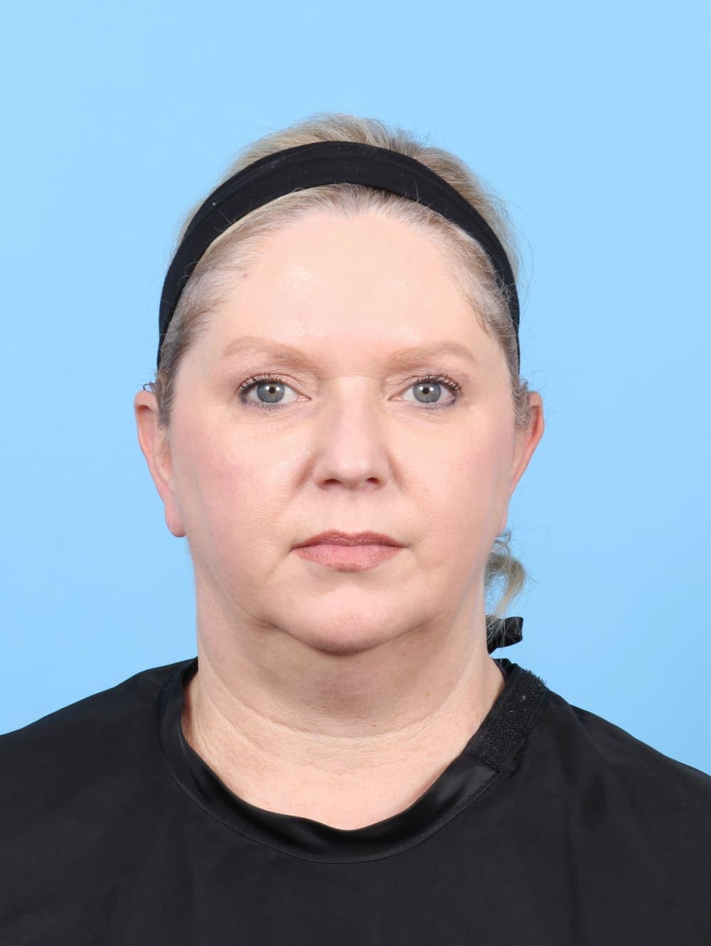 Eyelid Surgery case #6523 after, image 1
