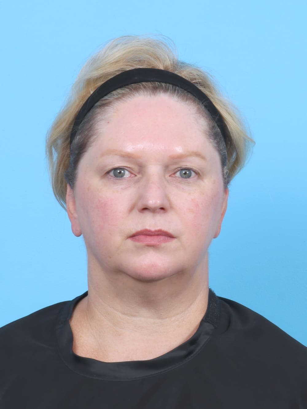 Eyelid Surgery case #6523 before, image 1