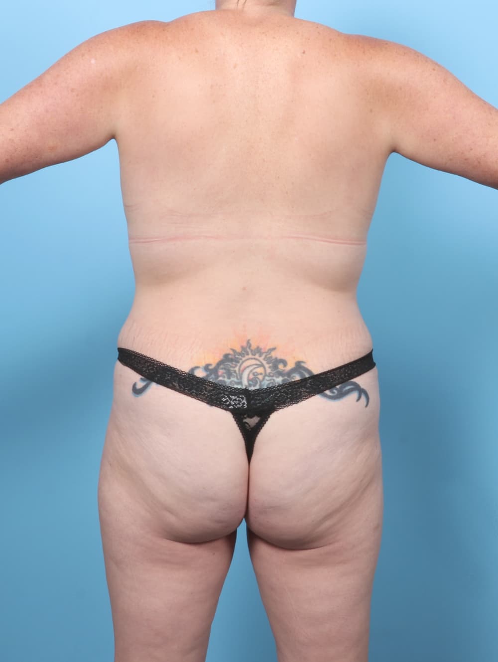 Liposuction case #8360 after, image 4