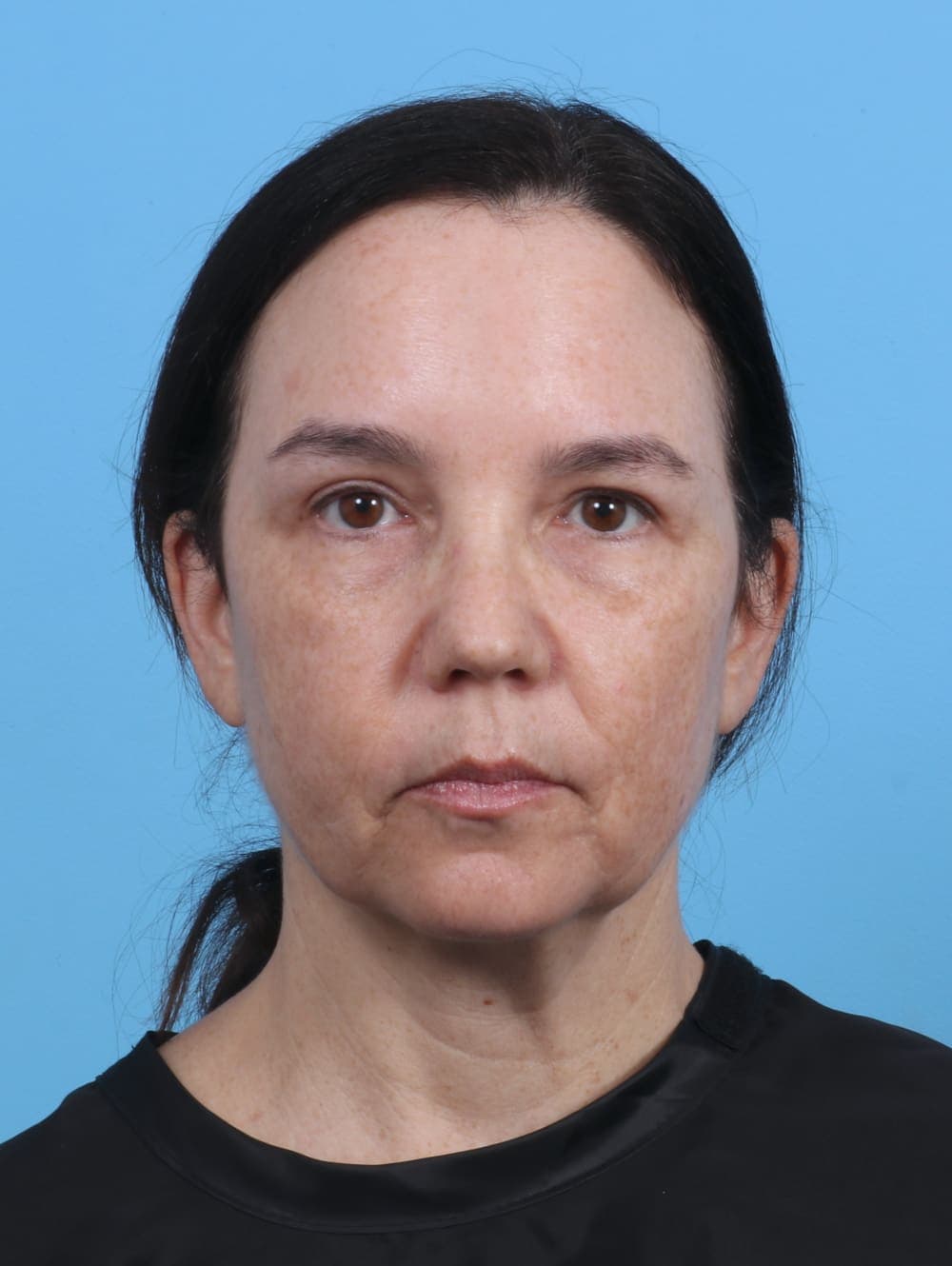 Eyelid Surgery case #4179 after, image 1