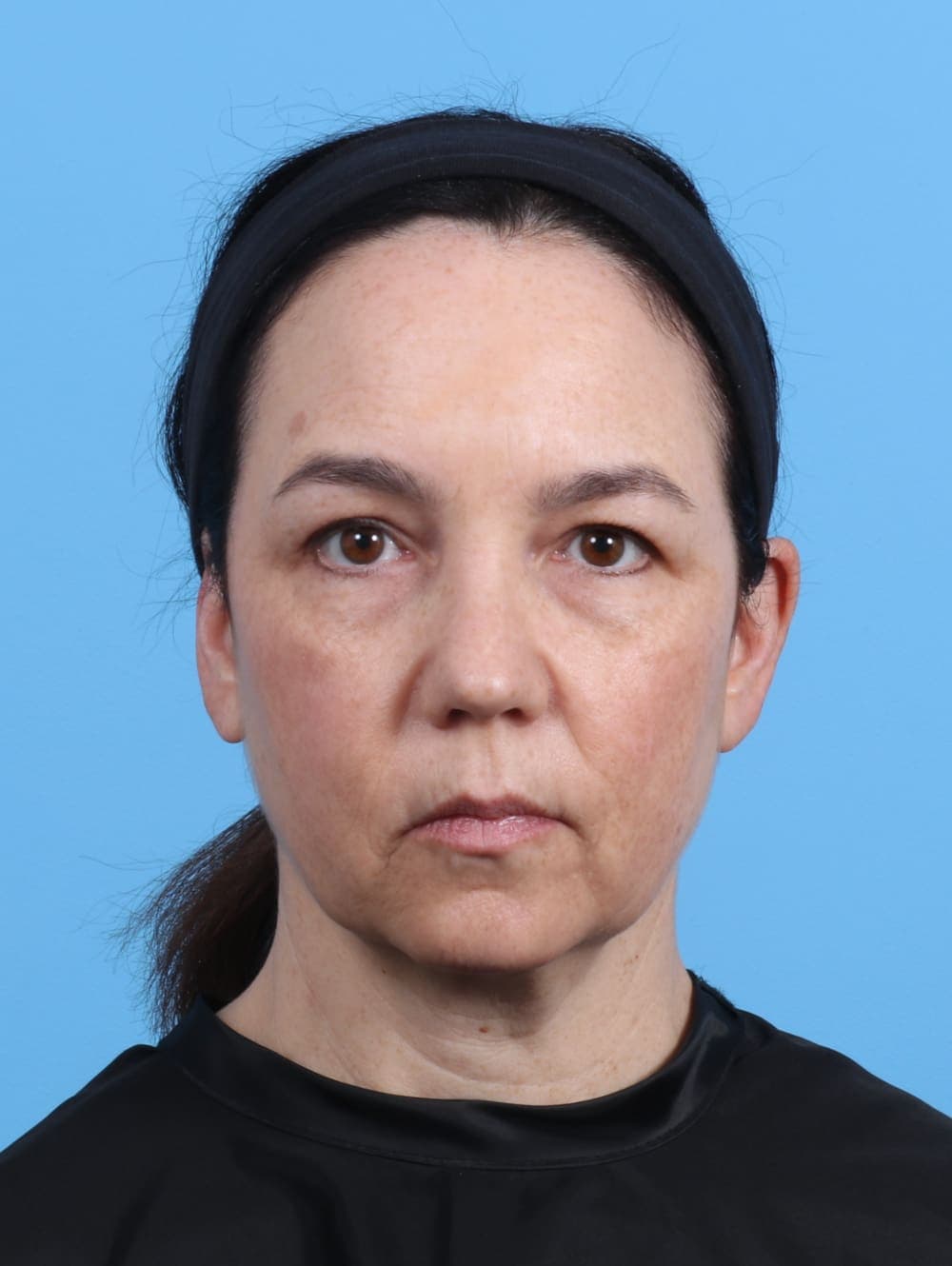 Eyelid Surgery case #4179 before, image 1