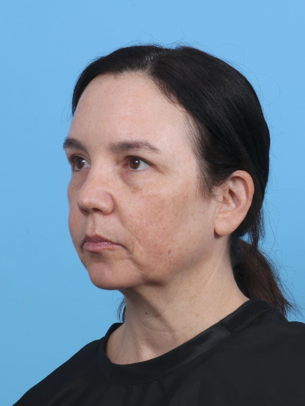 Eyelid Surgery case #4179 after, image 2
