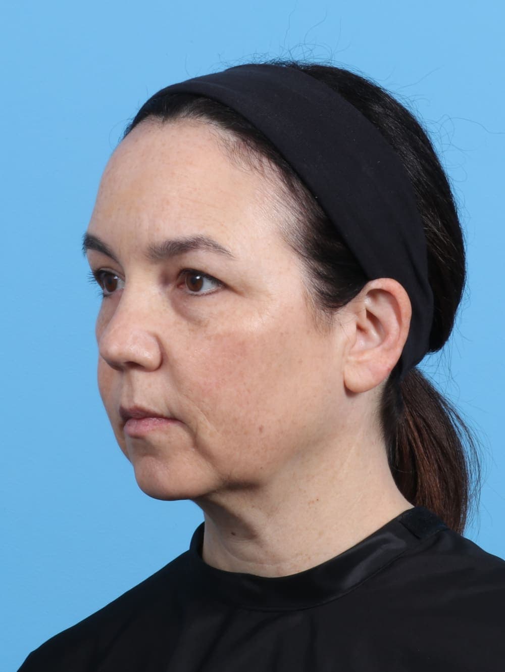 Eyelid Surgery case #4179 before, image 2