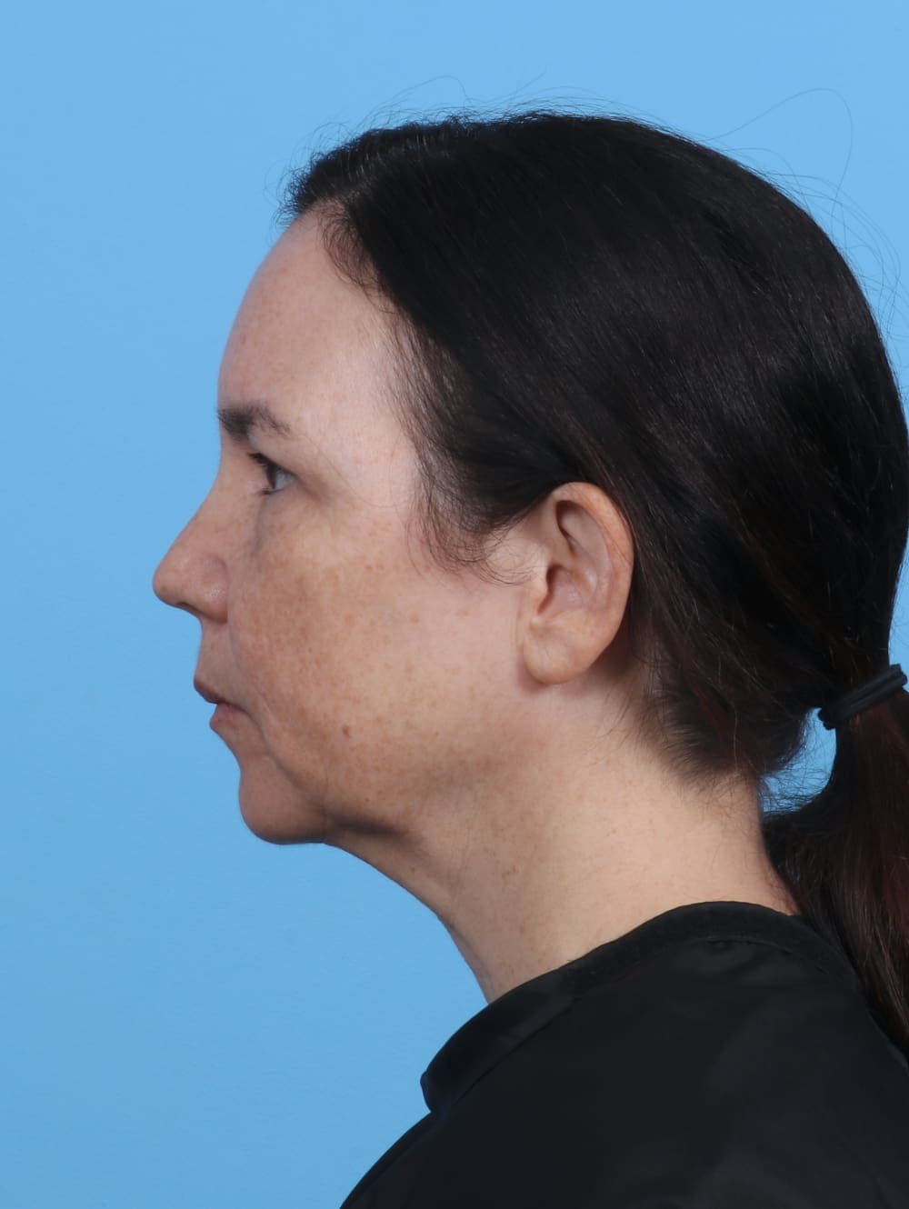 Eyelid Surgery case #4179 after, image 3