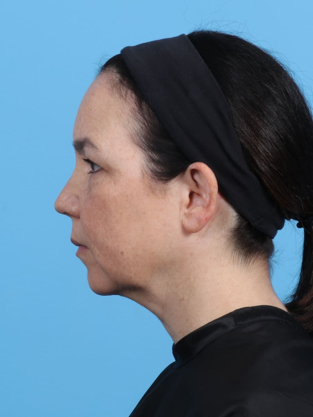 Eyelid Surgery case #4179 before, image 3