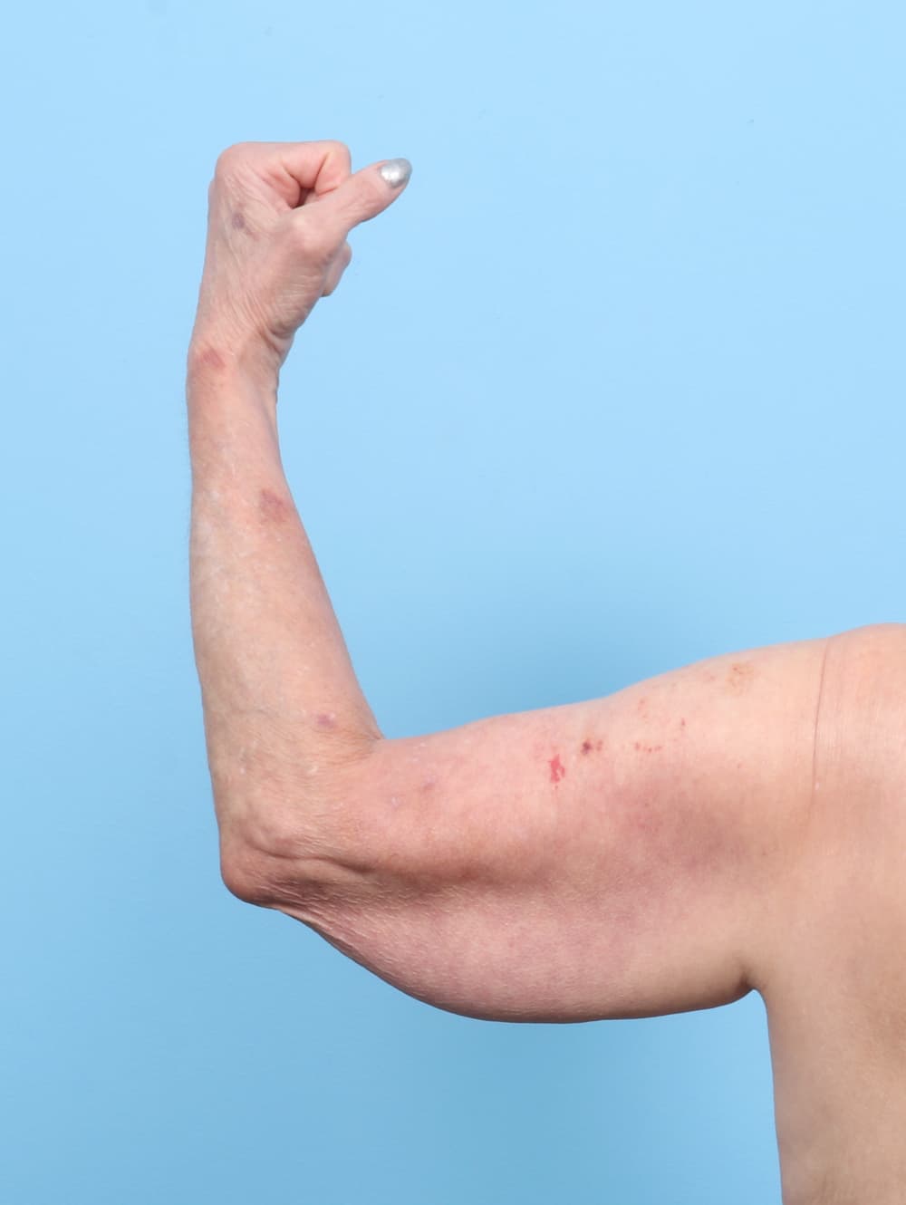 Arm Lift case #7960 before