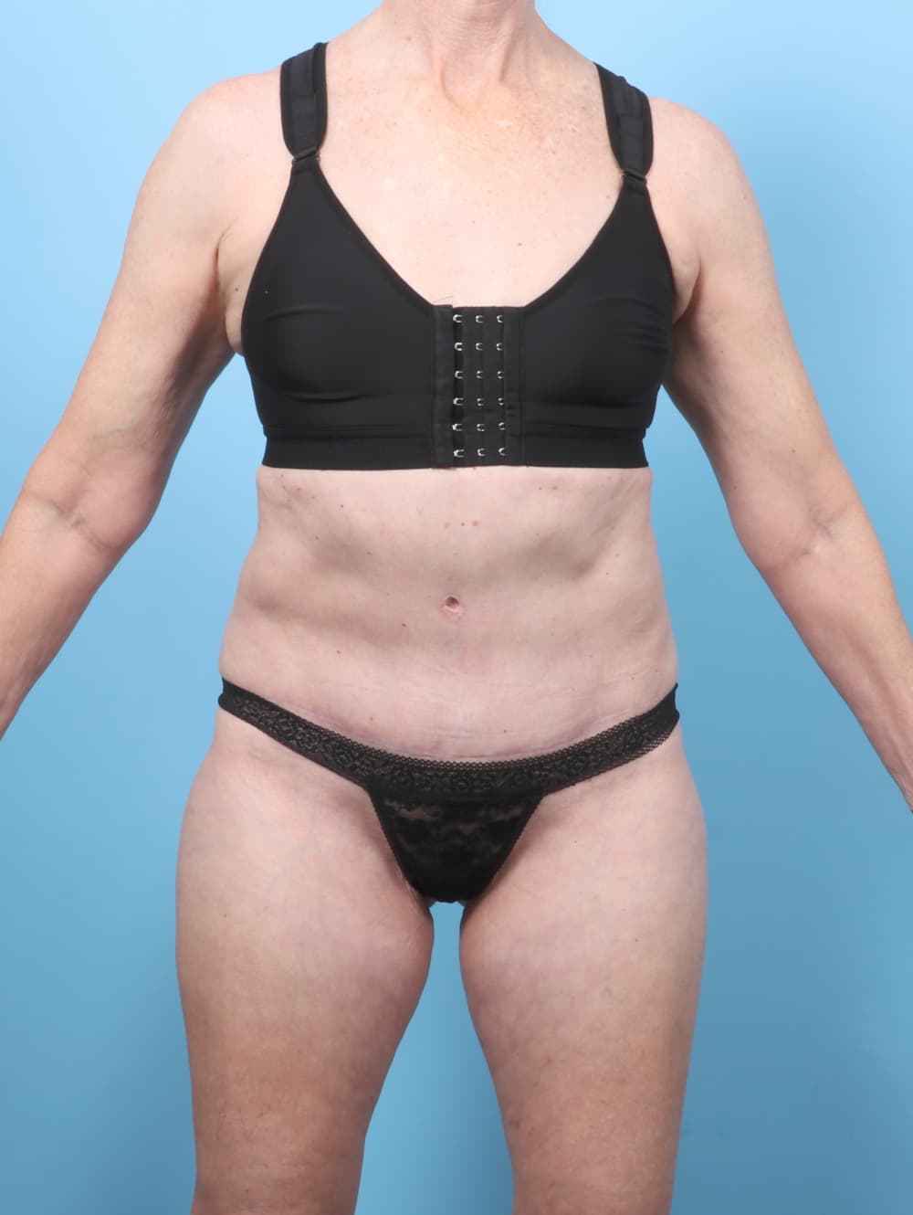 Tummy Tuck case #8046 after, image 1