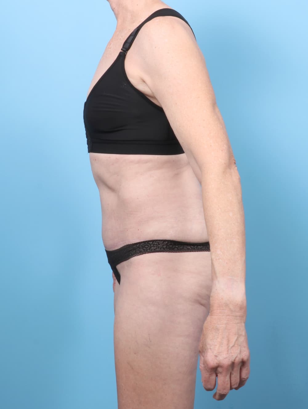 Tummy Tuck case #8046 after, image 3