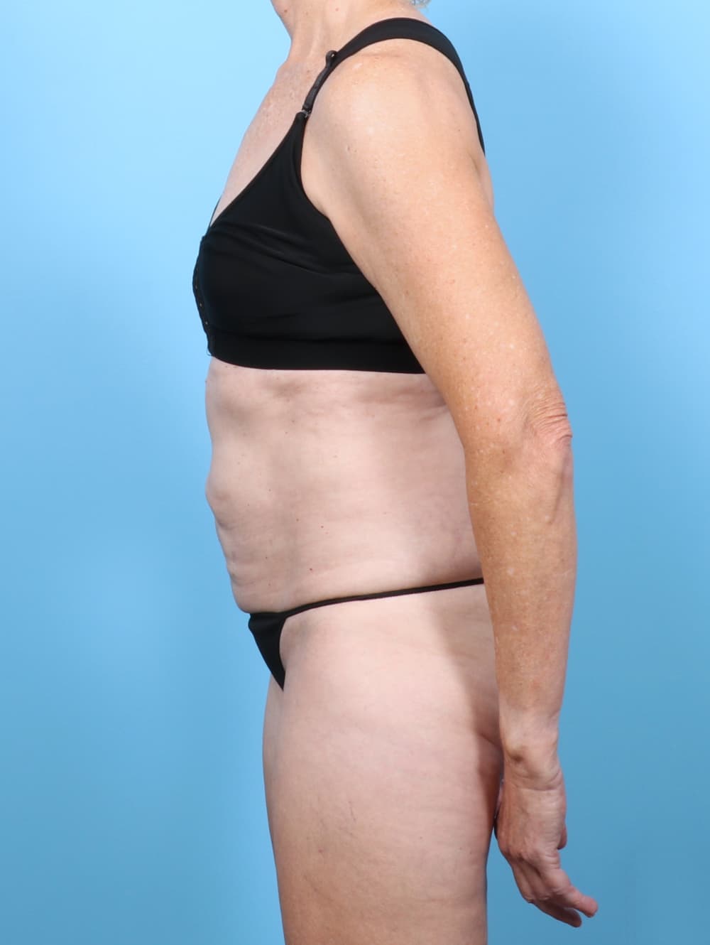 Tummy Tuck case #8046 before, image 3