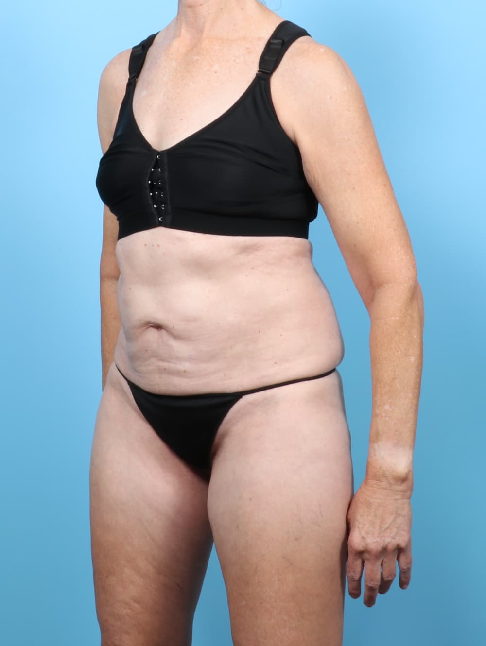Tummy Tuck case #8046 before, image 2