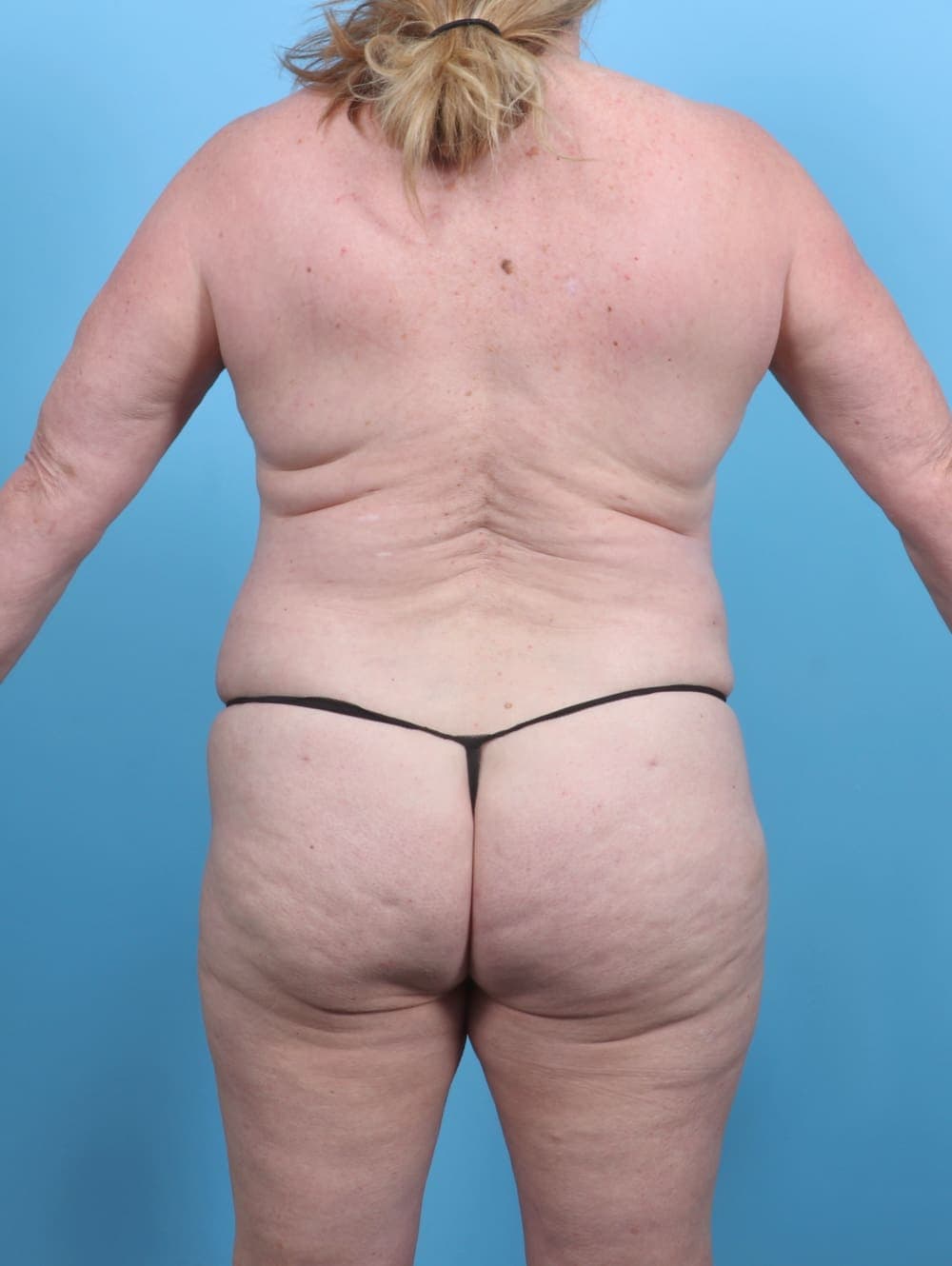 Liposuction case #5592 after, image 2