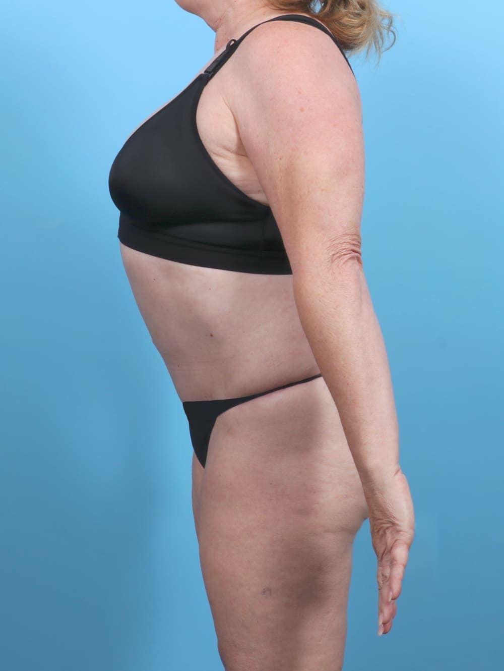 Liposuction case #5592 after, image 4