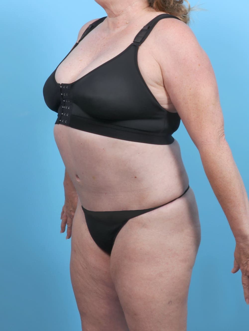 Liposuction case #5592 after, image 3